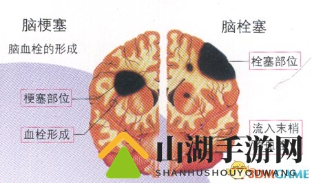少年沉迷游戏激战40小时，突发脑梗警示健康